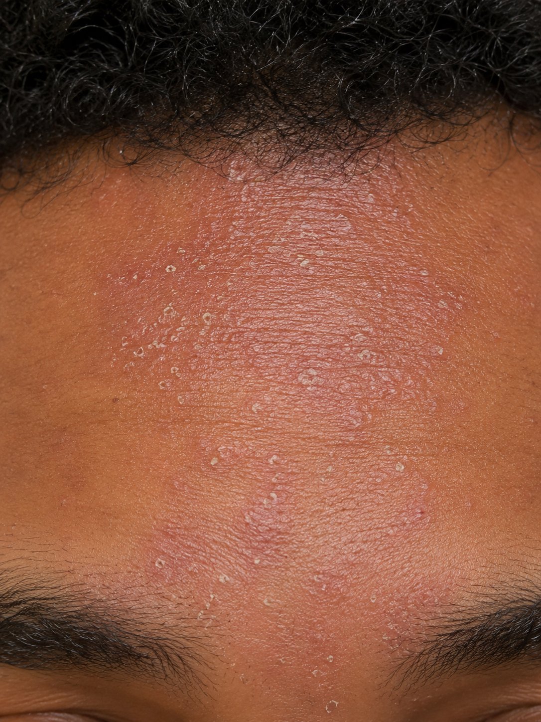 Close-up of fungal acne bumps along the hairline